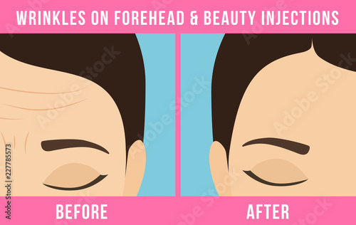 Women's anti-aging skin care. Different types of facial wrinkles. Woman before and after Botox injection. Anti-aging procedure. Vector