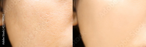 Compare before and after (retouch photo) of close up wide pores skin on oily face have pimple of asia woman photo