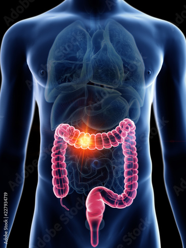 3d rendered medically accurate illustration of a mans colon cancer