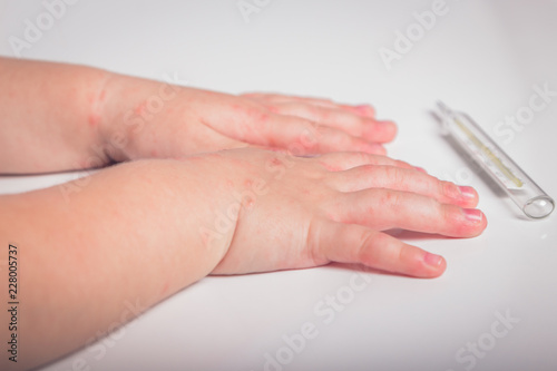 illness  fever  temperature  blisters in a child s arms  a thermometer