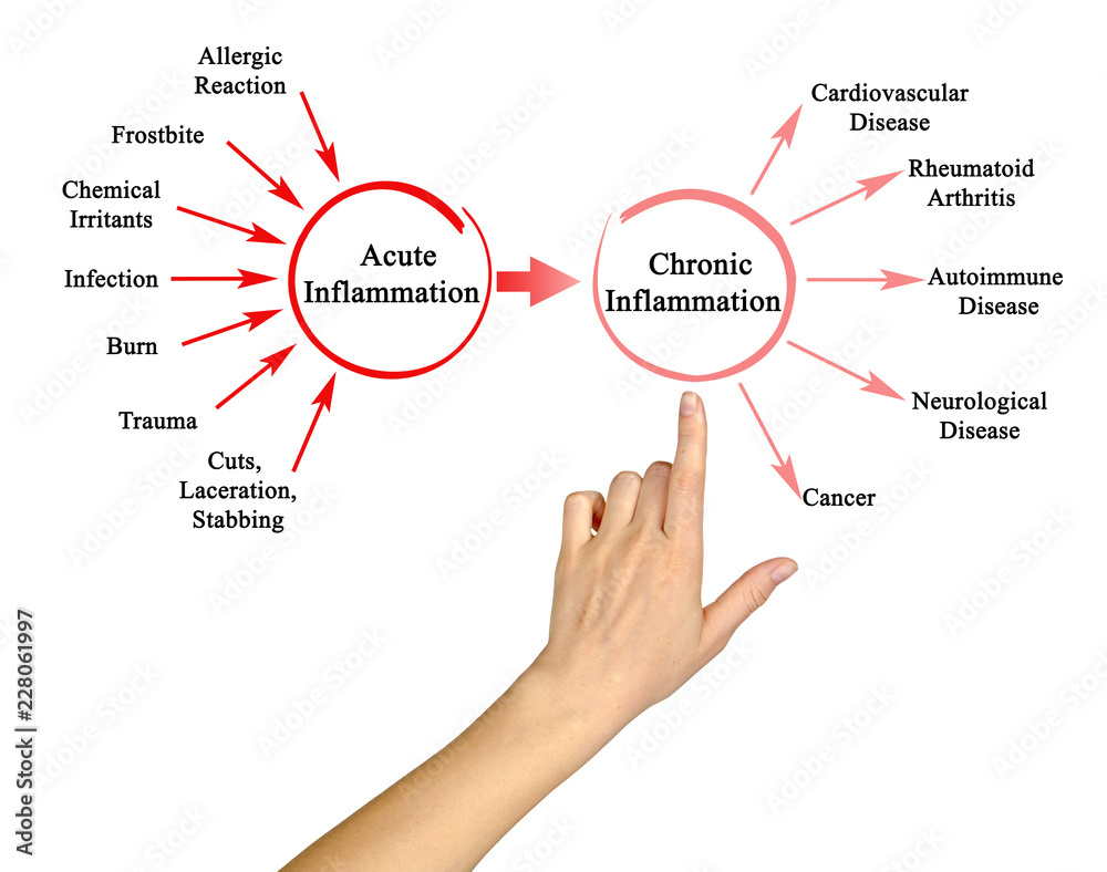 chronic-inflammation-is-that-all-there-is-to-disease-ambrose-cell