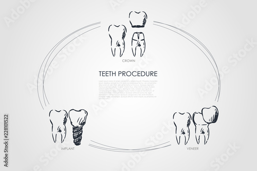 Teeth procedure - crown, veneer, implant vector concept set