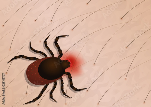 Tick with its head sticking in human skin, red blotches indicate an infection