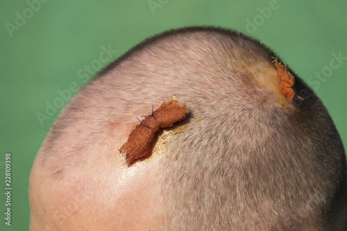 Stitched head in two places
