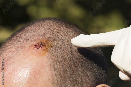 Doctor pointing on scar after remove stitches