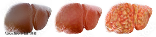 Realistic stages of a fatty liver - 3D Rendering photo