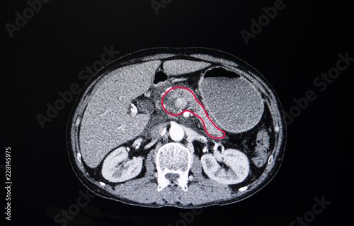  CT of carcinoma of the head of pancreas, pancreatic tumor.