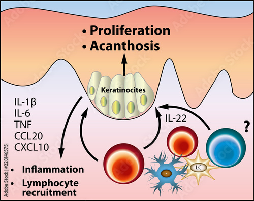 The pathogenesis of acanthosis nigricans scheme, vector medical illustration