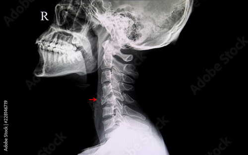 Xray of fractured cervical spine. Lateral neck film of spinal fracture. photo