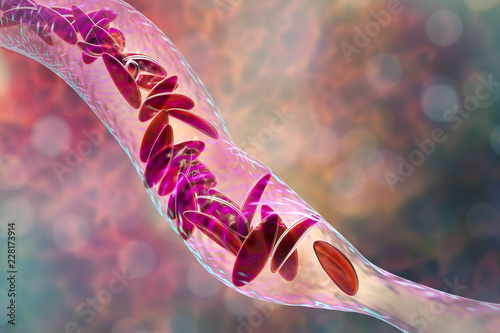 Sickle cell anemia, 3D illustration. Clumps of sickle cell block the blood vessel photo