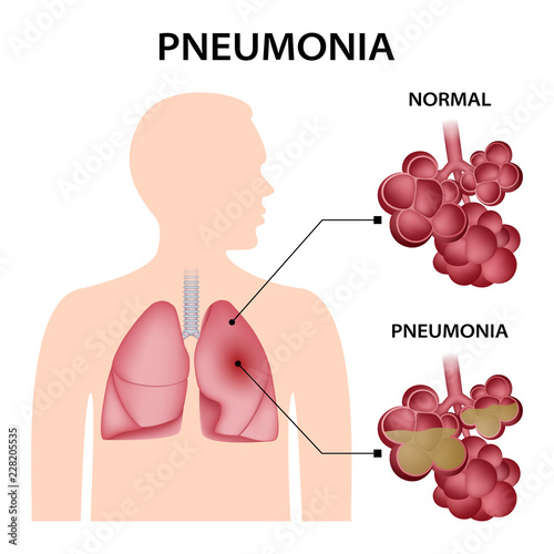 Pneumonia concept background. Realistic illustration of pneumonia vector concept background for web design