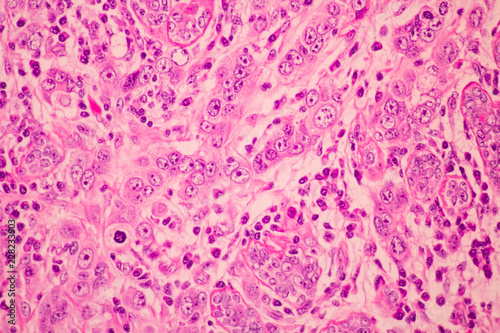 View in microscopic of pathology cross section tissue ductal cell carcinoma or adenocarcinoma diagnosis by pathologist in laboratory.H and E stain.Criteria of breast cancer.Medical concept. photo