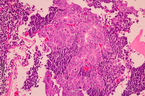 Foto View in microscopic of pathology cross section tissue ductal cell carcinoma or adenocarcinoma diagnosis by pathologist in laboratory