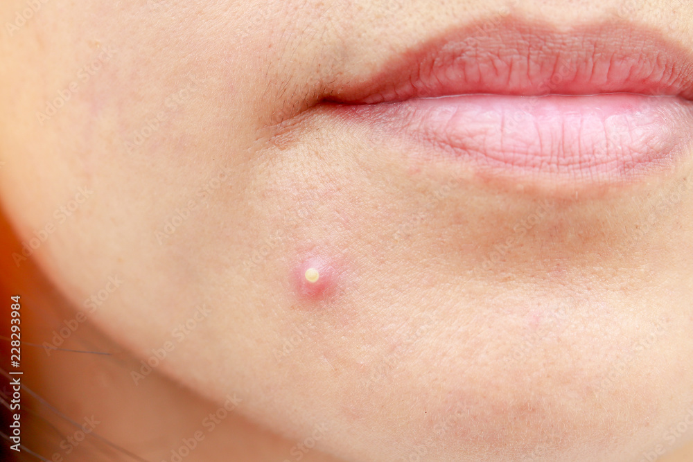 Fototapeta premium check skin and acne closeup