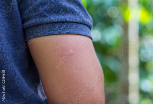 Reddened skin from mosquito bites in nature.