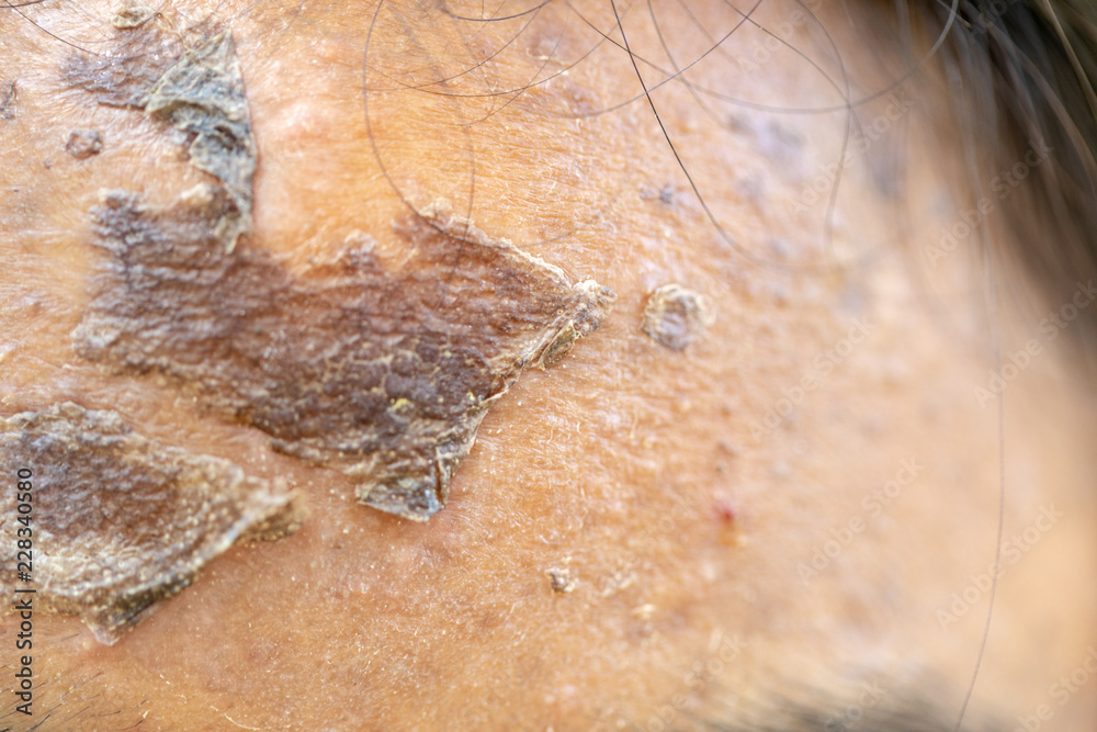 Fototapeta premium Backgrounds of lesions skin caused by acne on the face in the clinic.