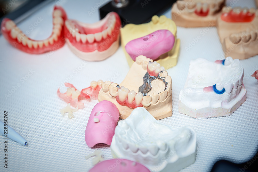 various samples of casts of dentures, close up various samples of casts of dentures, close up