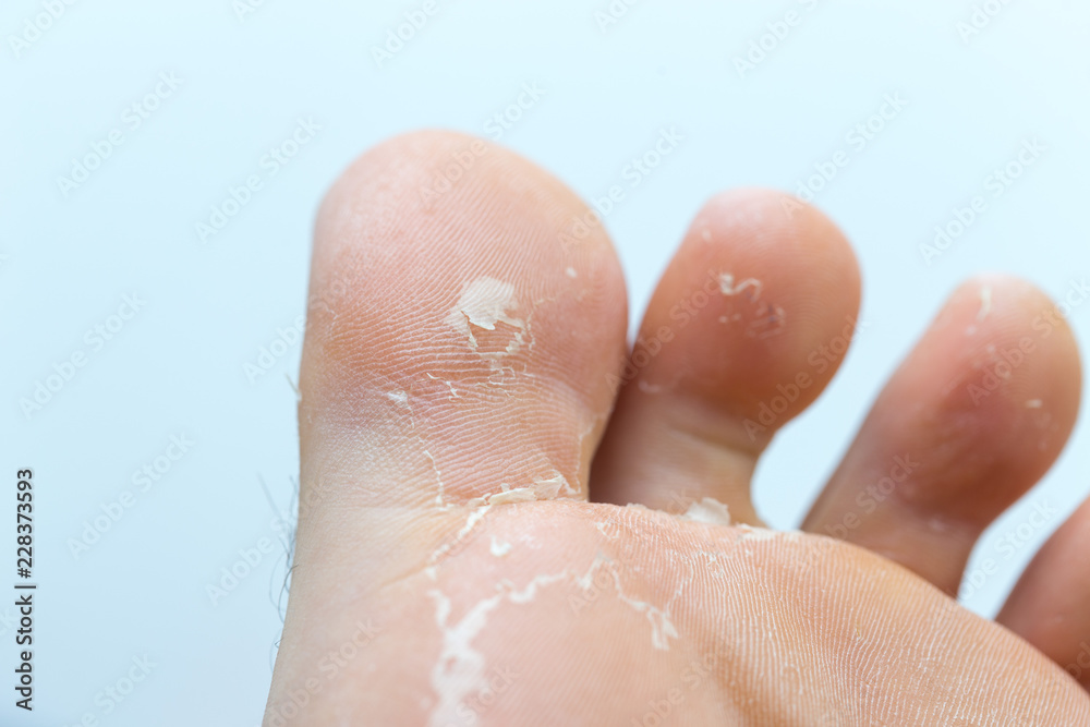 Fototapeta premium Callus on big toe isolated on white background