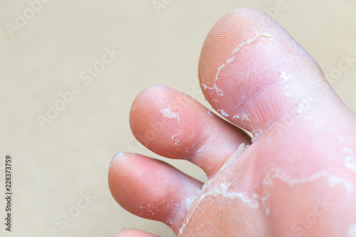 Callus on big toe isolated on white background © donikz