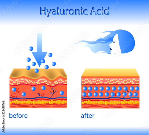 Vector illustration with cosmetic filler or Hyaluronic acid on light background