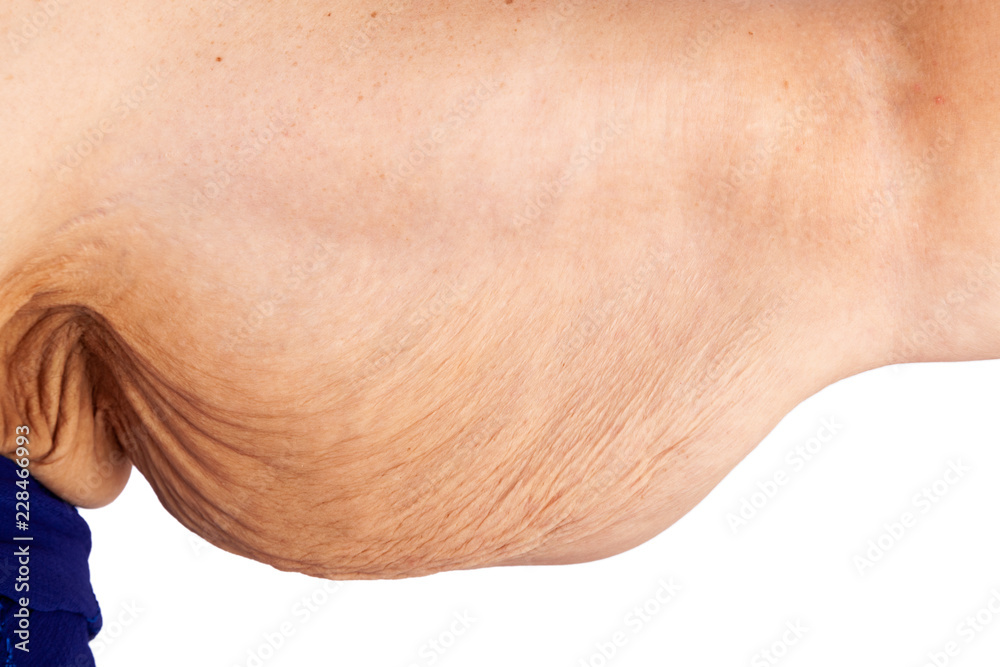 Naklejka premium Skin suit - Extreme Weight Loss Upper Arm