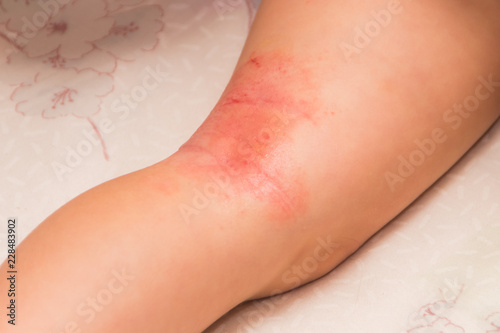 the child on the leg, Allergy, fungus flakes and covered with a crust, treated with ointment