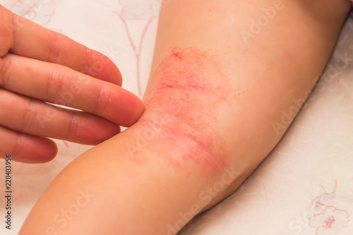 the child on the leg, Allergy, fungus flakes and covered with a crust, treated with ointment