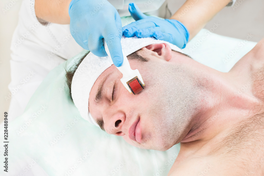 The man undergoes the procedure of medical micro needle therapy with a modern medical instrument derma roller. The man undergoes the procedure of medical micro needle therapy with a modern medical instrument derma roller.