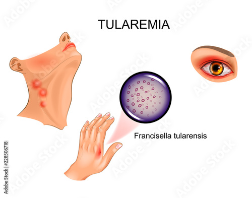 tularemia. hand bite. lymphadenitis and conjunctivitis photo