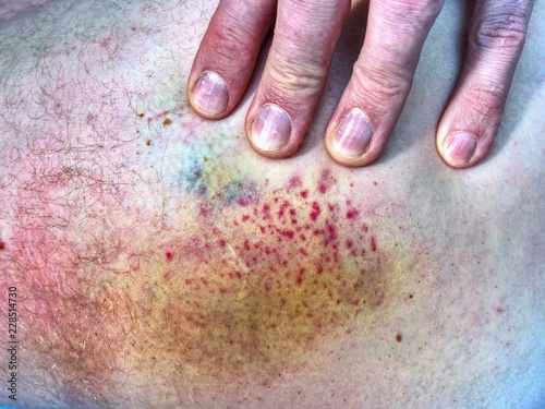 Bruised wound injury on human body. Patient show injured plaxe photo