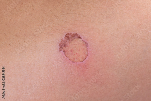 Arm scald,a wound from hot water