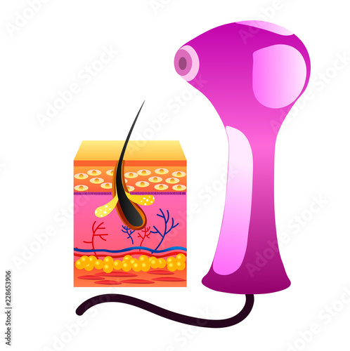laser hair removal, structure of the cell and a laser apparatus