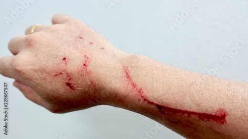 Scratch and Blood on arm after a man try to catch a domestic cat on the road, man's  arm placed on a board with a long slice/cut/wound going across it with blood on it drying up, Healthcare conceptual