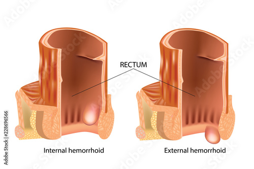 Medical illustration showing internal and external hemorrhoids. Types of Hemorrhoids. Hemorrhoids, also called piles, are vascular structures in the anal canal. photo