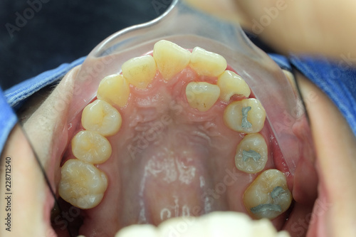 tooth malocclusion in upper jaw
