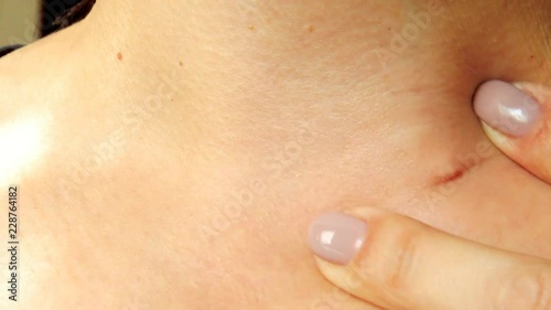 Defect on the skin, pinch.