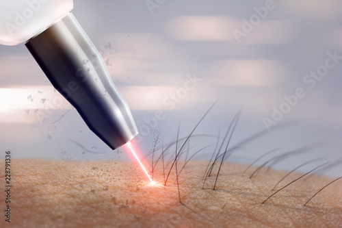cosmetology procedure laser hair removal on body parts. Laser epilation. photo