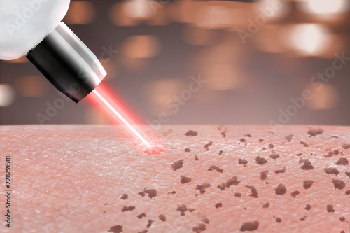 cosmetology procedure laser freckle skin removal on body parts. close up © bumbumbo