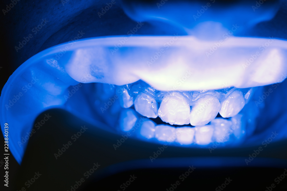 Bleaching of the teeth at dentist clinic. UV Whitening teeth. Repair  cracked or fractured teeth and remove teeth. Stock Photo