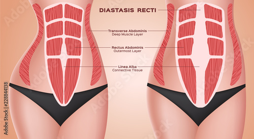 diastasic recti . abdominal . before after pregnancy vector / anatomy photo