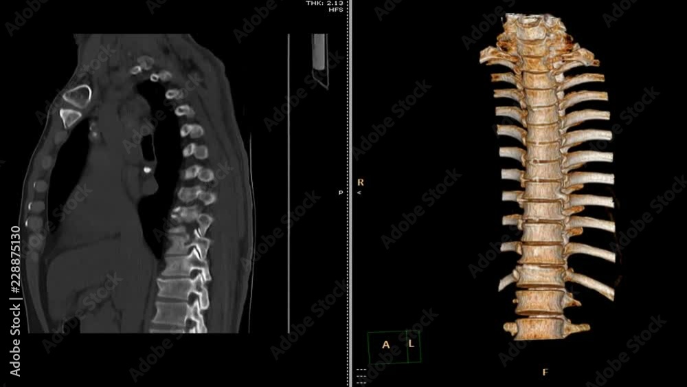 computed tomography ,CT scan of thoracic spine 2D and 3D rendering ...