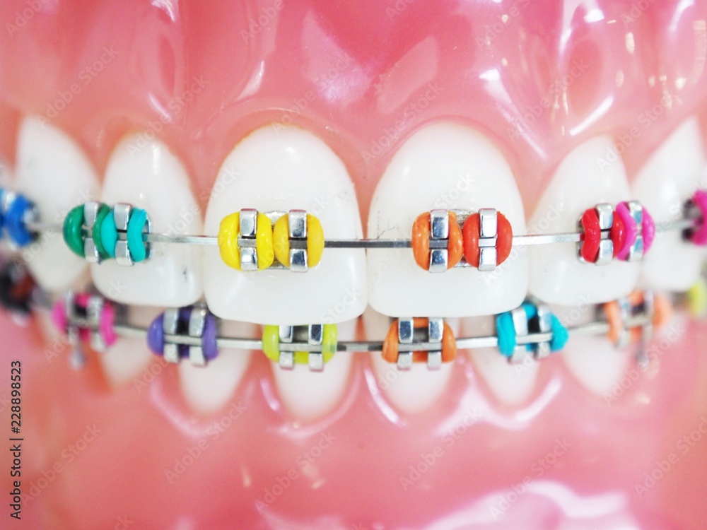 Foto Stock Close up orthodontic model and dentist tool demonstration