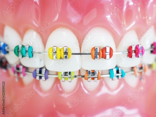 Close up orthodontic model and dentist tool - demonstration teeth model of multi color of orthodontic bracket or brace photo
