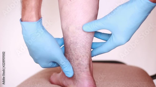 Doctor palping varicose veins