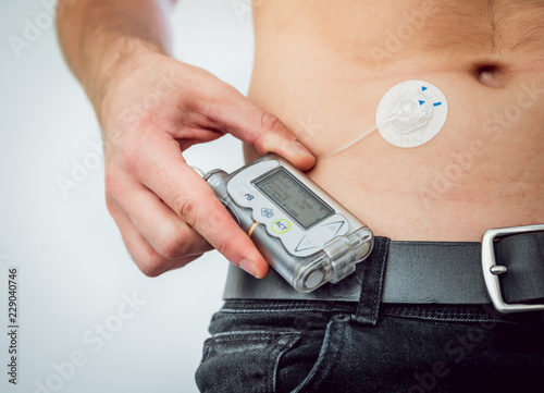 Billede på lærred Diabetic man with an insulin pump connected in his abdomen and keeping the insulin pump on his belt