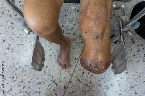 below knee amputation