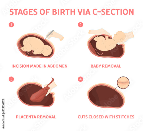 Stages of baby birth via cesarean section photo