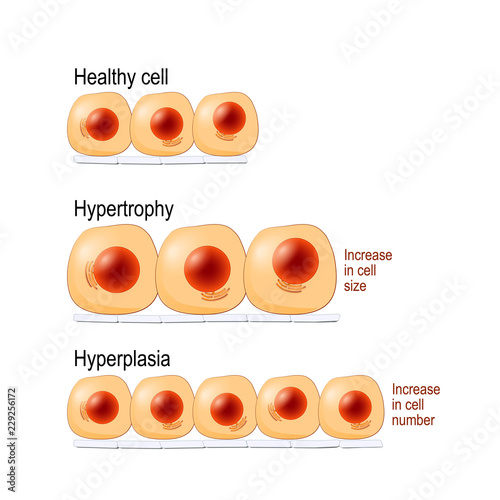 Normal cells, hypertrophy, and hyperplasia photo
