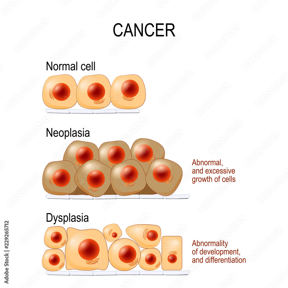 Cancer. Normal cells, Dysplasia, and Neoplasia