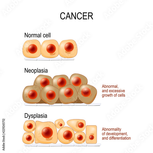 Cancer. Normal cells, Dysplasia, and Neoplasia photo